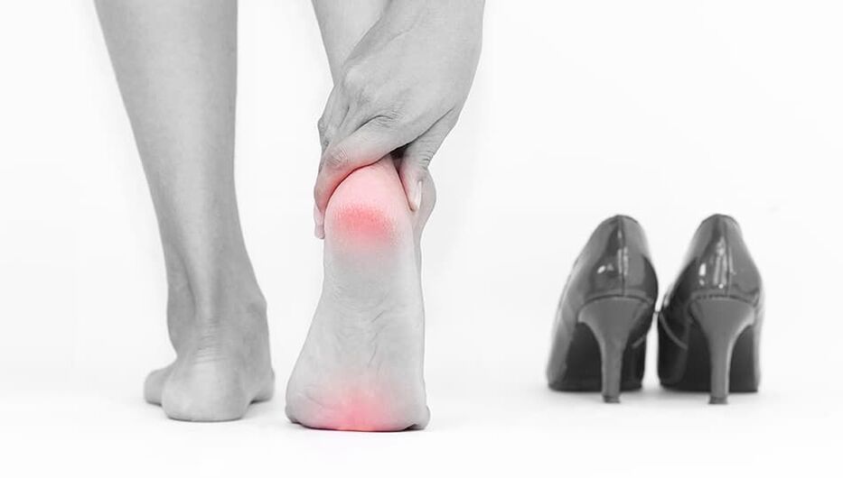 Der Grund für das Aussehen von Krampfadern sind die unangenehmen Schuhe. 
