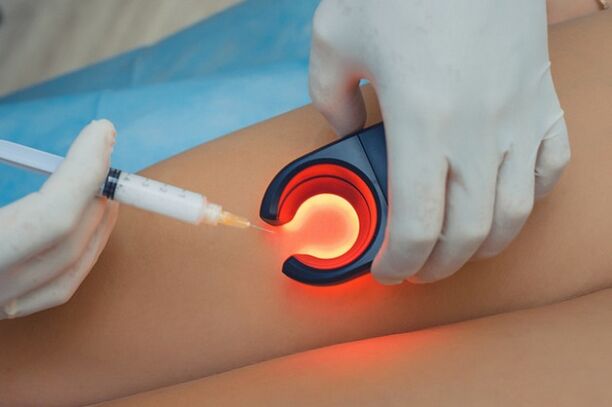 Behandlung von Krampfadern mittels Sklerotherapie.