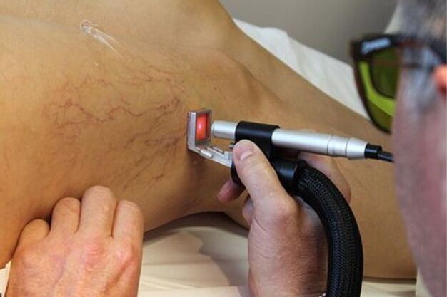 Laserbehandlung von Krampfadern der unteren Extremitäten.