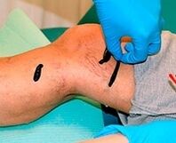 Sanguijuelas für Krampfadern