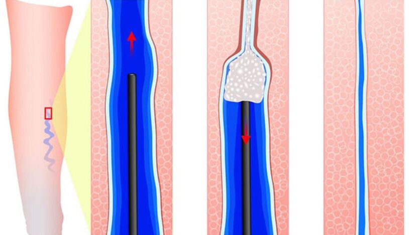 Einführung von Sclerosantes bei Esclerostiapia